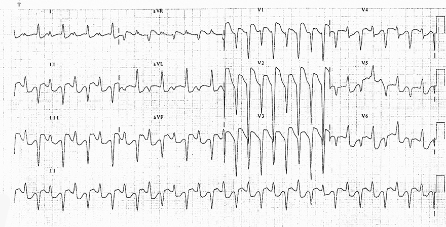 ECG digoxim toxicity, Bidirectional ventricular tachycardia (BVT)