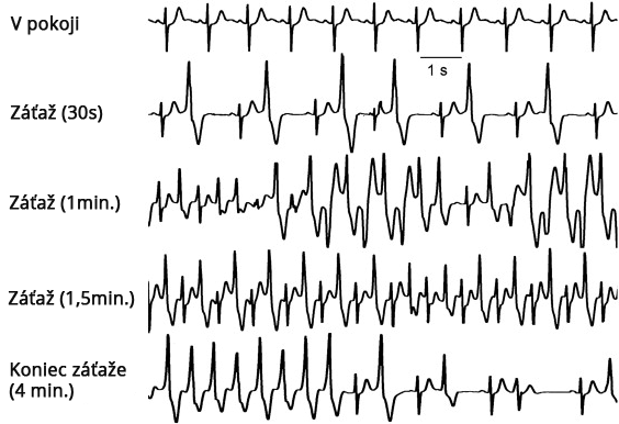 ECH exercise, Cathecholaminergic Polymorphic Ventricular Tachycardia