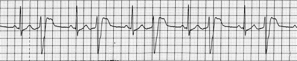 ECG premature ventricular complex (PVC), ventricular bigemini