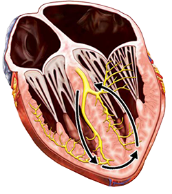 Bundle Branch Re-entrant Ventricular Tachycardia