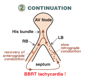 Continuation Branch Re-entrant Ventricular Tachycardia