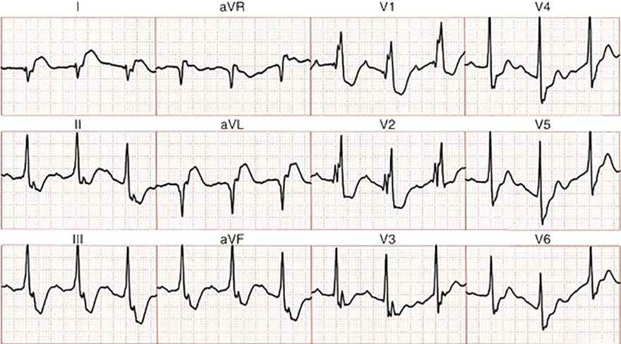 ECG RBBB, left posterior fascicular block, First degree AV block