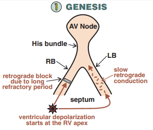 Genesis Bundle Branch Re-entry Ventricular Tachycardia