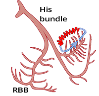 Fascicular ventricular tachycardia reentry, anterograde and retrograde conduction