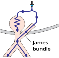 Lown-Ganong-Levine (LGL) syndrome, James bundle (atria to bundle of His)