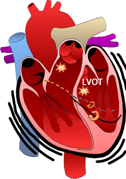 Idiopathic Left Ventricular Outflow Tract (LVOT) Tachycardia