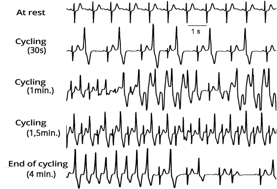 ECH exercise, Cathecholaminergic Polymorphic Ventricular Tachycardia