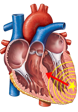 Unifocal ventricular tachycardia, one ectopic ventricular focus, electrical ventricular vector, ventricular activation