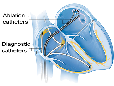 Electrophysiology Study (EPS) and Catheter Ablation