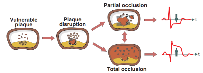 ACS, Vulnerable plaque, Plaque disruption, Stenosis (partial occlusion), Total occlusion, ST segment elevation, ST segment depression