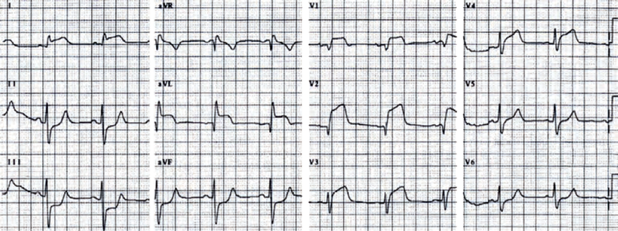 ECG acute coronary syndrome with ST elevation, acute anterior STEMI infarction