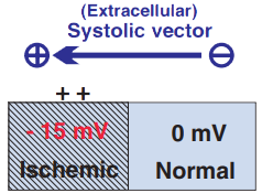 Systolic extracellular ischemic vector