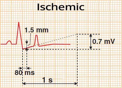 ST Segment and Ischemia - ECG book