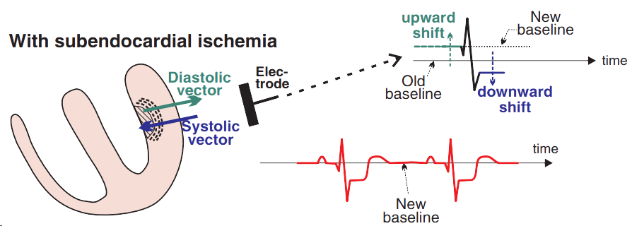 Subendocardial ischemia, old ECG baseline, new ECG baseline, diastolic vector, systolic vector, ST depression