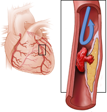 Acute coronary syndrome, proximal LAD occlusion