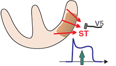 ECG STEMI (ST Elevation Myocardial Infarction)