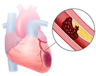 coronary artery occlusion: Ischemia, Injury and Infarction (necrosis)