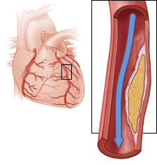 Unstable angina pectoris, proximal left anterior descending artery stenosis