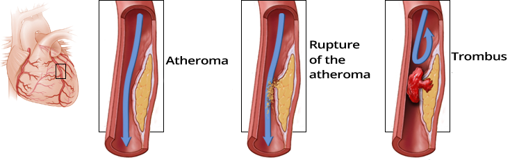 Mechanism acute coronary syndrome, formation of an occluding thrombus, atheromatous plaque