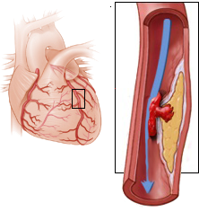 Unstable angina pectoris, proximal left anterior descending artery stenosis