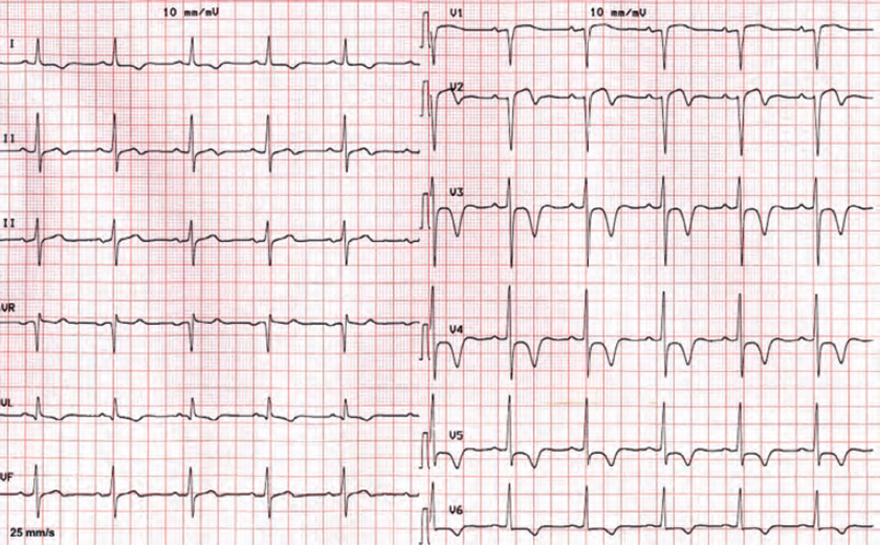 ECG cardiac ischemia, sinus rhythm, T wave inversion (I, aVL, V2-V6), ST elevation (V1-V2), DDX ischemia, or acute STEMI