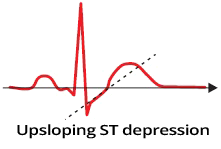 ECG upsloping ST segment depression, No ST segment elevation acute coronary syndrome, unstable angina, NSTEMI