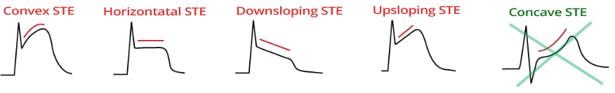 STEMI ST elevation, convex, straight upsloping, straight horizontal, straight downsloping 