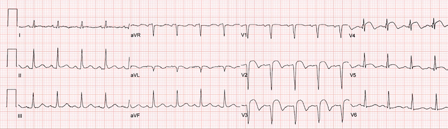 ECG subacute (hours - days) anterior STEMI infarction, occlusion LAD