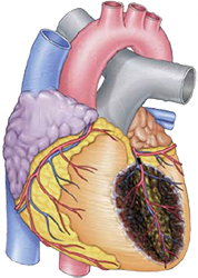 Subacute anterior STEMI infarction, anterior wall STEMI, LAD occlusion - culprit vessel - artery