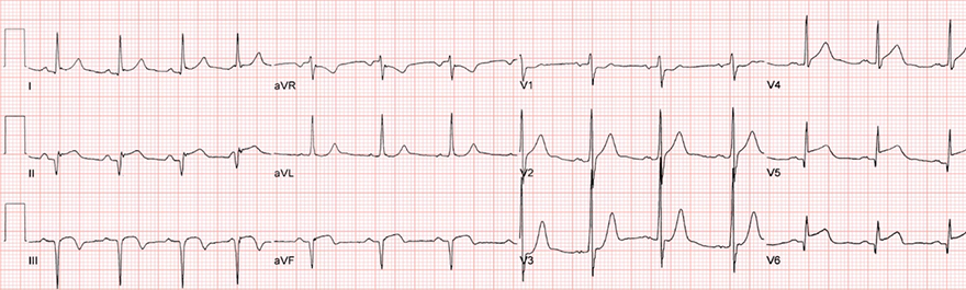 ECG pathological Q wave, old (weeks - years) inferior and lateral wall STEMI infarction, occlusion LCx