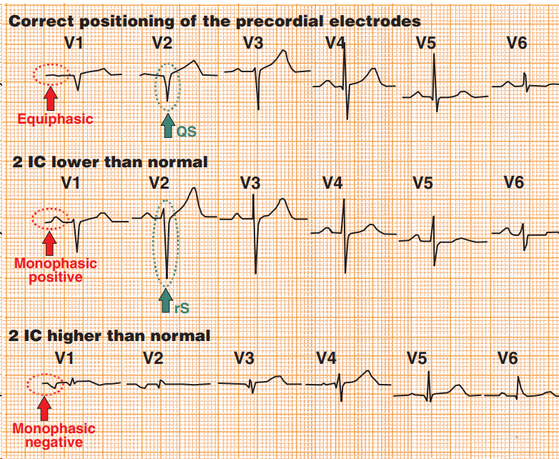 ECG erroneous diagnosis of anteroseptal myocardial infarction, Left anterior hemiblock (LAF)