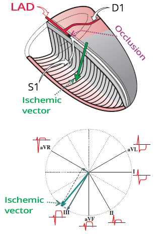 Anterior STEMI, LAD occlusion between D1 and S1 (distal to first diagonal branch, proximal to first septal branch), electrical vector, ST elevation, ST depression