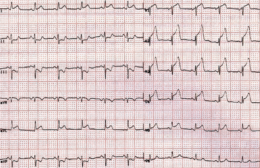 ECG anterior STEMI infarction, ST elevation (V2-V5, I, aVL), reciprocal ST depression (II, III, aVL), culprit artery - vessel: LAD between S1 and D1