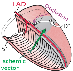 Left anterior descending artery, culprit artery - first diagonal branch of LAD