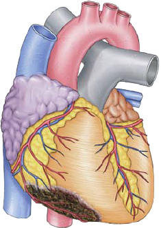 Inferior Wall STEMI (ST Segment Elevation Myocardial Infarction), LAD culprit artery