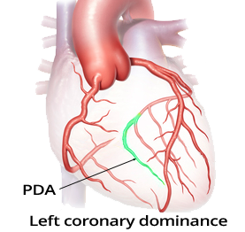 Coronary artery dominance, posterior descending artery (PDA), Left-dominant