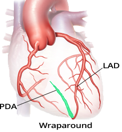 Coronary artery dominance, posterior descending artery (PDA), Wrap-around