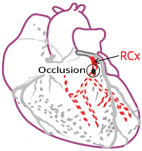 proximal left circumflex artery occlusion, infero-lateral STEMI infarction