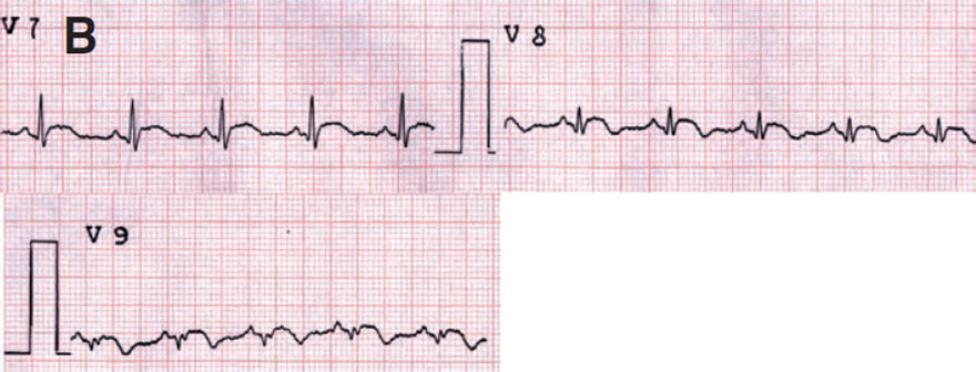 ECG posterior STEMI infarction, ST elevation in posterior leads (V7-V9)