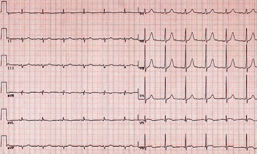 ECG old posterior infarction with pathologic R wave (V1)