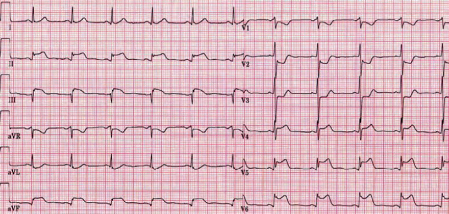 ECG acute posterior inferior and lateral STEMI infarction, proximal right coronary artery occlusion