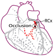 Isolated Posterior Wall Myocardial Infarction, distal RCx occlusion