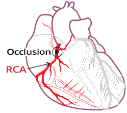 Dominant Right coronary culprit artery, inferior and posterior STEMI infarction