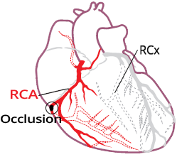 Distal right coronary artery occlusion, right STEMI infarction, inferior STEMI infarction, left circumflex artery, culprit vessel, ECG (V4R lead)