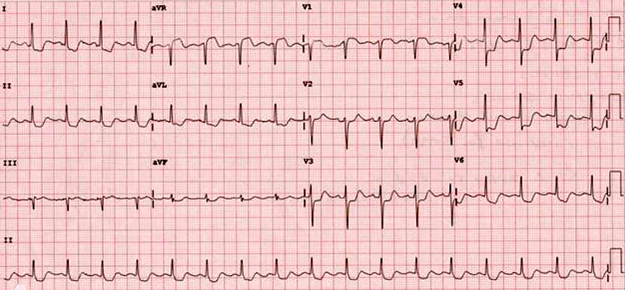 ECG ST elevation (aVR), Left main coronary artery occlusion, ST elevation in aVR, widespread horizontal ST depression