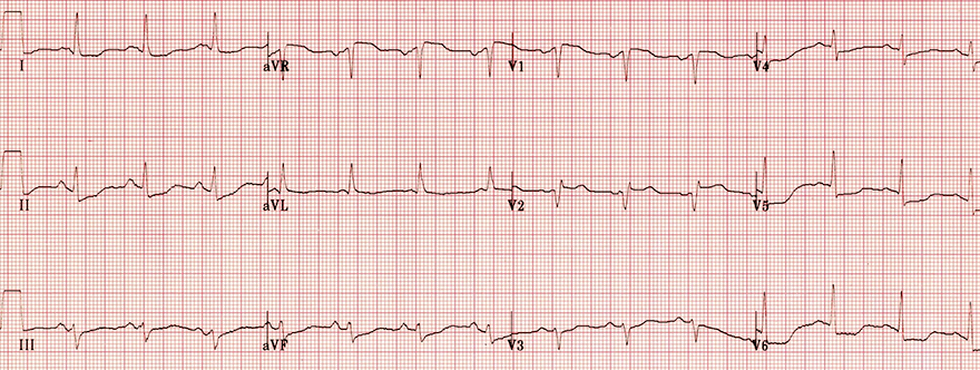 ECG ST elevation in aVR, subacute septal STEMI, widespread ST depression