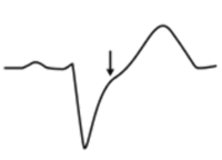 ECG Sgarbossa criteria LBBB and STEMI, discordant ST depression (V1-V3)