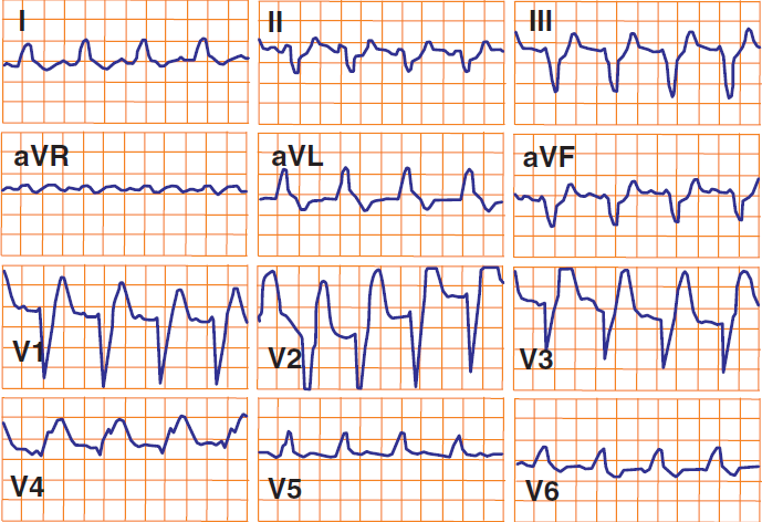 ECG sgarbossa criteria, STEMI and LBBB, Concordant ST elevation greater than 1mm, Excessively discordant ST elevation greater than 5 mm