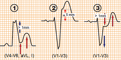 ECG Sgarbossa criteria STEMI infarction with LBBB, ST elevation, concordant ST depression