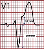 ECG (V1) Sgarbossa criteria, concordant ST depression